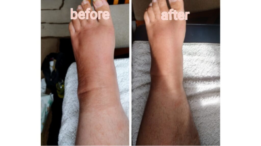 before and after lymphatic drainage