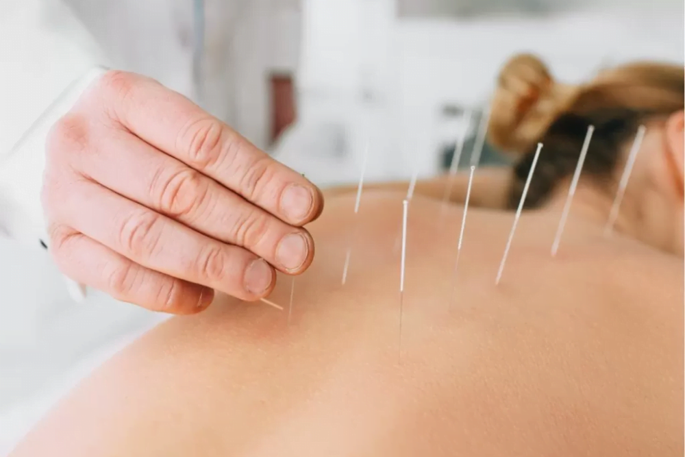 Dry needling