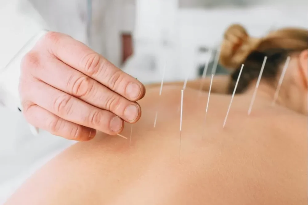 Dry needling